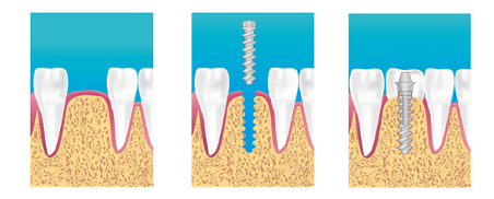 implant dentaire Toulon 