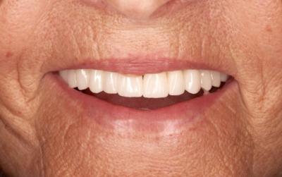 Implant dentaire Toulon