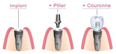 Composants implant dentaire Toulon 83000